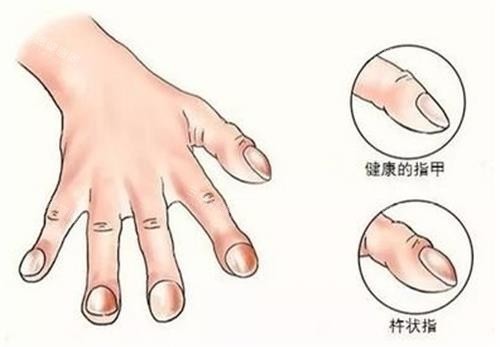 手指畸形的示意图