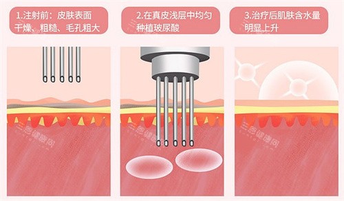 打一次=敷100片面膜？艾维岚新品上瘾红85mg水光注射体验报告，敏感肌也能安心冲！