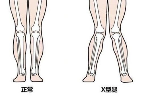 南宁有好的腿型矫正机构吗？南宁华美、爱思特、东方、格林美菲、芭芘丽是南宁有名的腿型矫正医院