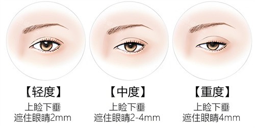 双眼皮提肌vs没提肌：如何选择让眼睛更有神？靠谱改善方案这里看！