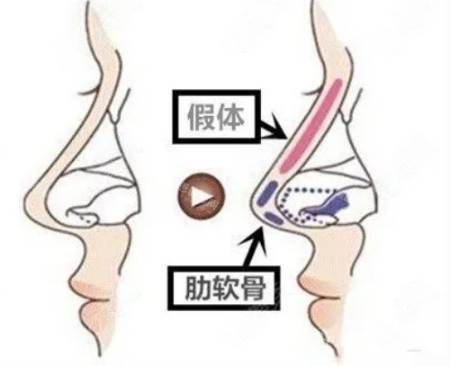 隆鼻示意图