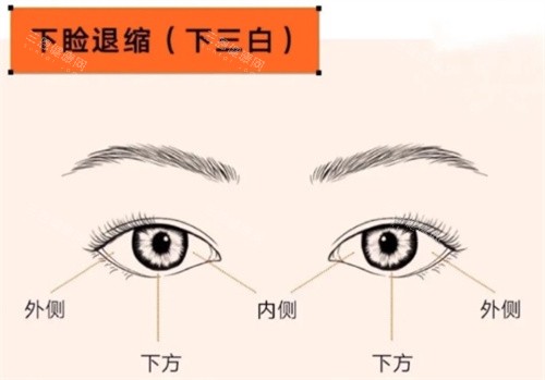 眼修复眼修复下睑退缩