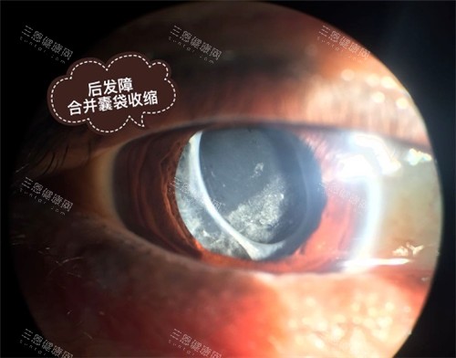 后发障囊带收缩