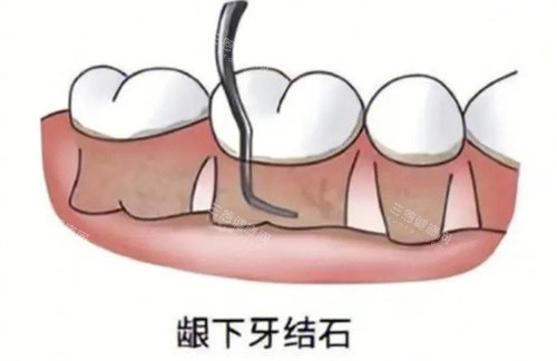 龈下刮治