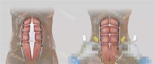 美人鱼腹壁成形术的过程 美人鱼腹壁成形术的过程
