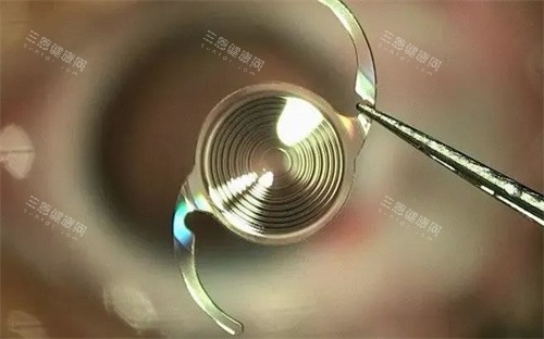 广西医学大学二附院眼科白内障手术咋样?飞秒激光无刀技术+三焦点晶体植入