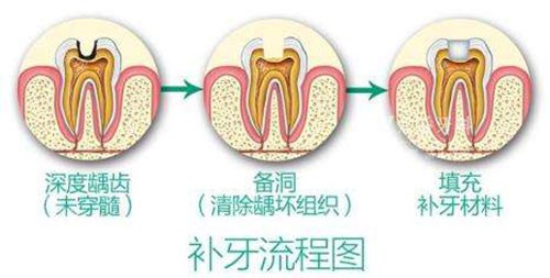东莞补牙齿价格查询，2025玻璃补牙300元起、树脂补牙国产150元起、进口树脂350元起！