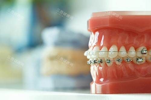 东莞牙齿矫正价格多少钱？牙齿金属矫正4980元起、陶瓷矫正1万元起、隐形牙套18800元起！