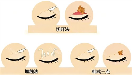 开封启美做眼睛整形多少钱？埋线/全切/眼综合价格对比！