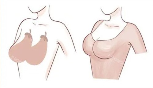 郑州乳房悬吊提升哪家好？这五家医院技术稳、口碑好！
