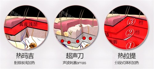 谭永嘉医生面部提升技术如何？微拉美价格大概多少？术后能维持几年？真实术例对比分享！