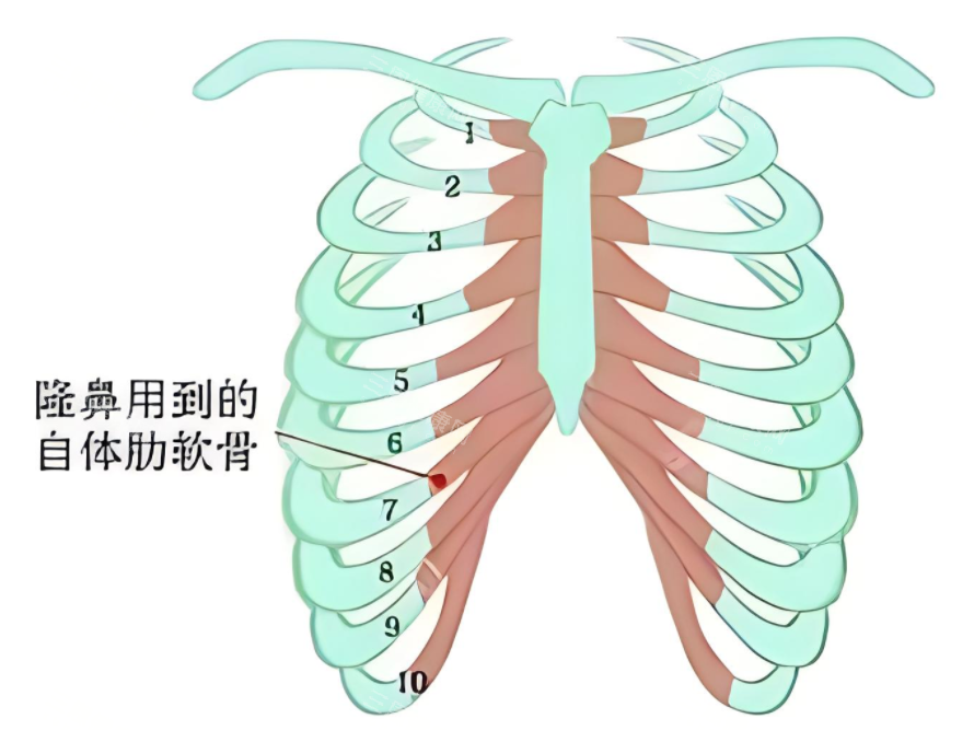 隆鼻肋骨鼻所用肋骨
