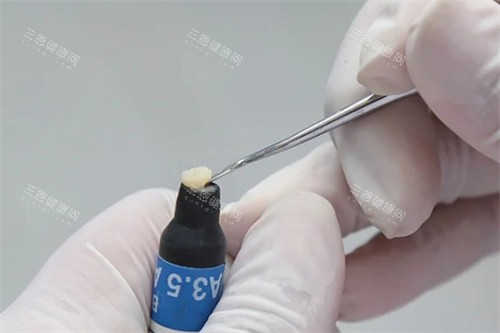 广州楚庭口腔医生取补牙树脂
