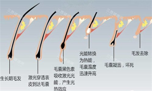 光电仪器脱毛前后对比