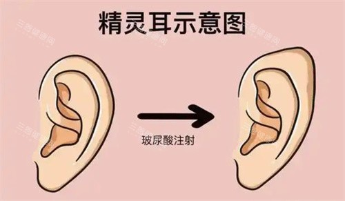 精灵耳注射