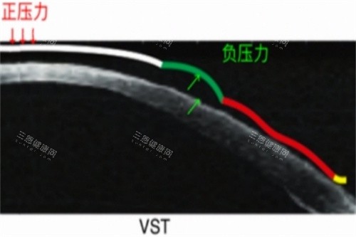 VST角膜塑形镜力的示意图