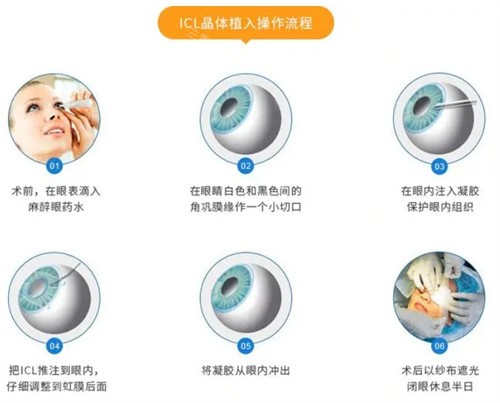 zmb00晶体属于强生吗？属眼力健，TECNIS平台打造双焦点款/适配东方阅读距离/集采价4938+！