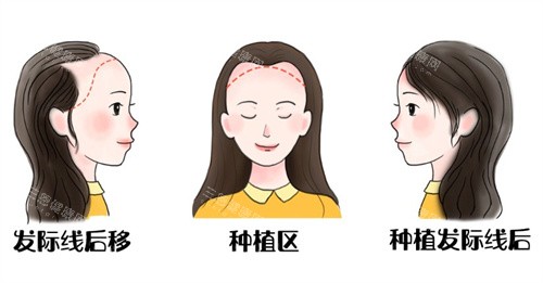 福州重森植发正规认证：医生三证齐全+无菌操作，植发后3月显结果！