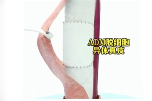 AMD生物补片示意图