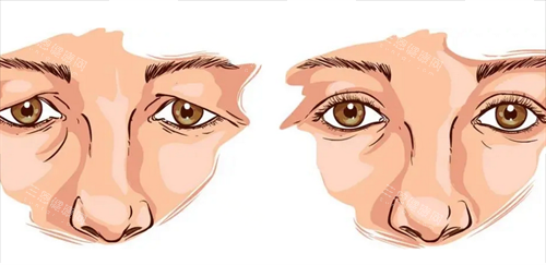 双眼皮修复前后