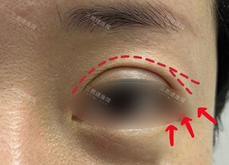 双眼皮眼尾开叉