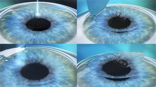 个性化微飞秒手术过程图 个性化微飞秒手术过程图