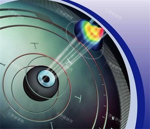 个性化微飞秒手术前角膜地图导航检测过程图 个性化微飞秒手术前角膜地图导航检测过程图