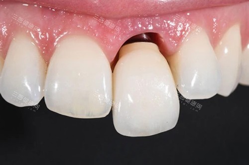 种植牙牙冠松动模型图 种植牙牙冠松动模型图