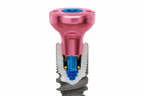 种植牙基台透视图 种植牙基台透视图