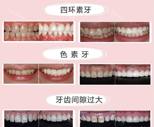 不同牙齿需要美白的示意图