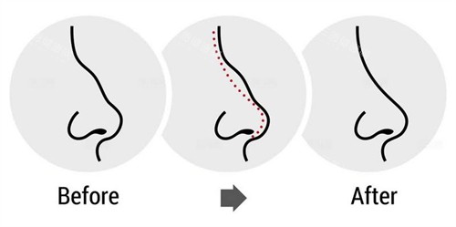 驼峰鼻子的改变过程图 驼峰鼻子的改变过程图