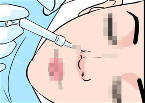 玻尿酸注射鼻子动画展示 玻尿酸注射鼻子动画展示