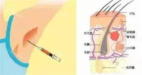 兰州大学第二医院整形外科做腋臭手术结果如何？术后修复和费用问题一文说清楚！
