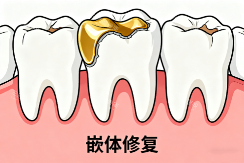 牙齿嵌体修复卡通图 牙齿嵌体修复卡通图