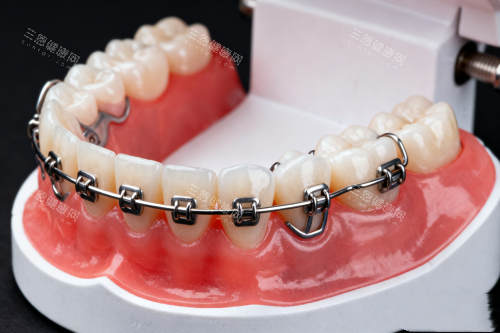 传统牙齿矫正器模型展示图