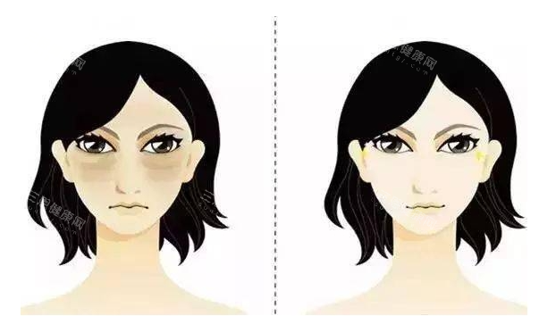 泪沟黑眼圈前后对比示意图 泪沟黑眼圈前后对比示意图
