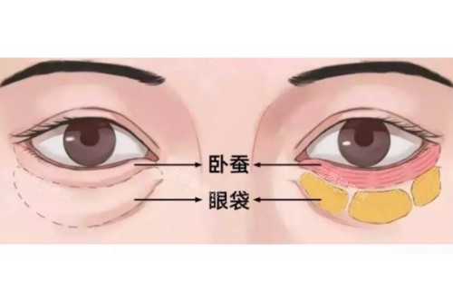 眼袋、卧蚕区分图 眼袋、卧蚕区分图