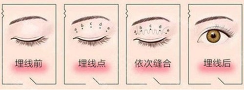 埋线双眼皮过程示意图片 埋线双眼皮过程示意图片