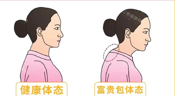 富贵包手术 富贵包手术