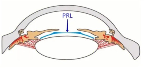 PRL晶体植入术放置位置 PRL晶体植入术放置位置