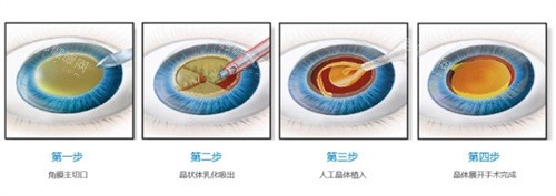 白内障手术过程 白内障手术过程