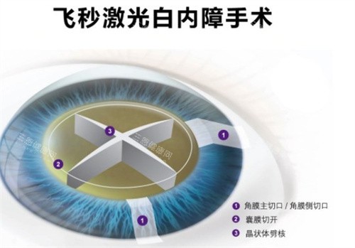 淮南做白内障手术是免费的吗？仅针对特困户和五保户实行全免费！