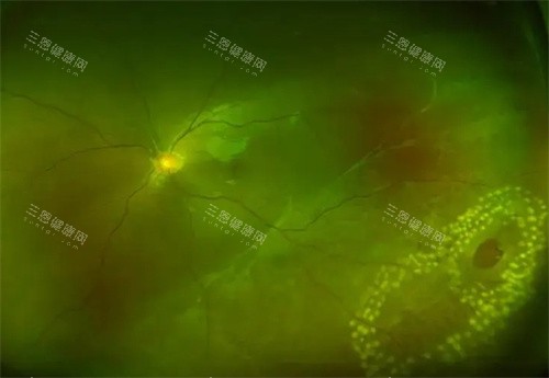 孔源性视网膜脱离灯下细节 孔源性视网膜脱离灯下细节