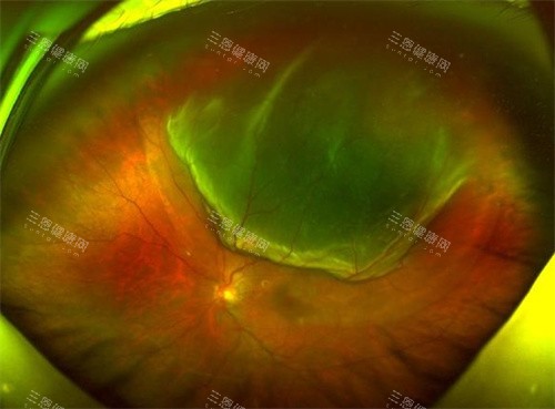 孔源性视网膜脱离细节 孔源性视网膜脱离细节