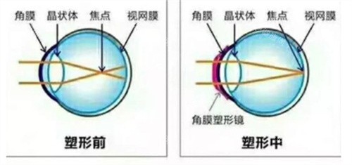 角膜塑形镜塑形时 角膜塑形镜塑形时