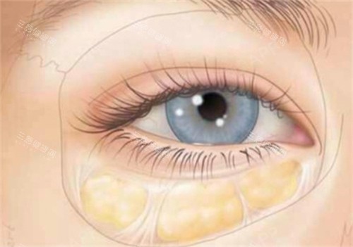 眼袋所在位置 眼袋所在位置