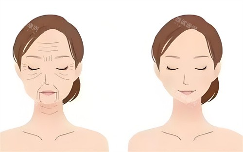 眼袋手术前后对动画图 眼袋手术前后对动画图