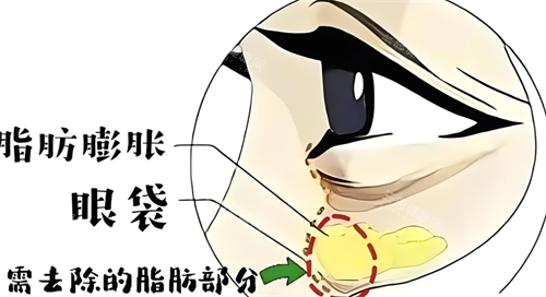 眼袋形成的原因 眼袋形成的原因