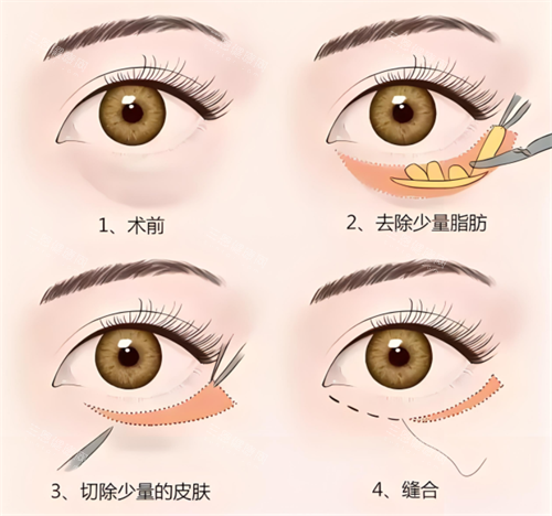 外切祛眼袋术原理 外切祛眼袋术原理