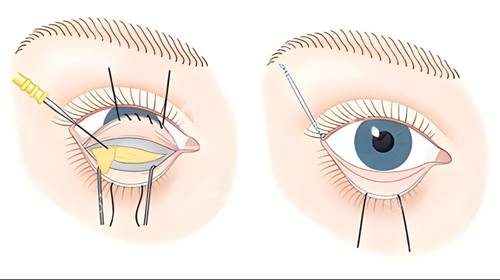 内切祛眼袋图 内切祛眼袋图